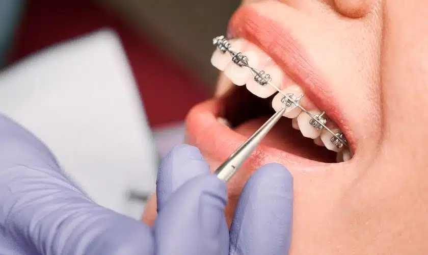 Orthodontics Bite
